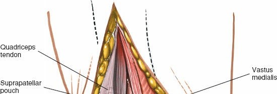 Illustration 35 for Mastering Knee Approaches: Spotlight on Superficial Medial Ligament