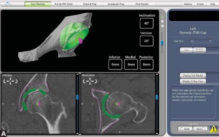 Illustration 6 for Robotics in Total Hip Arthroplasty: A New Era of Precision
