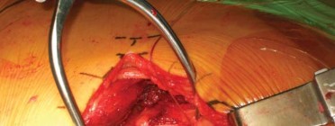 Illustration 102 for Successful Total Hip Replacement in Developmental Dysplasia