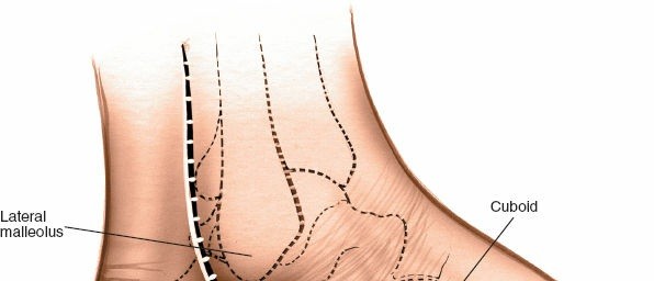 Illustration 187 for Optimized Approaches to the Dorsum of the Foot & Ankle