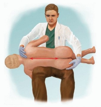 Illustration 3 for Duchenne Muscular Dystrophy: Is Spinal Fusion the Answer?