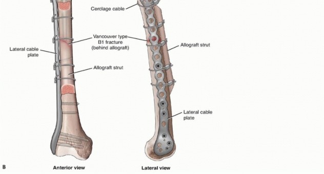 Illustration 17 for Mastering Fixation of Periprosthetic Fractures of the Femur