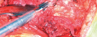 Illustration 25 for Cementless Femoral Stems: Master Indications & Avoid Pitfalls