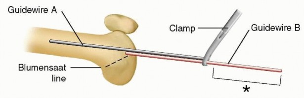 Illustration 16 for Retrograde Femoral Nailing: Optimizing Surgical Outcomes