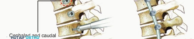 Illustration 10 for Anterior Thoracic Corpectomy: Decompression, Stabilization, Fusion