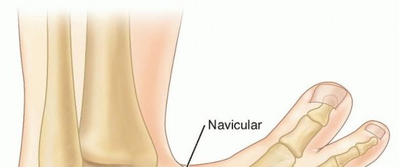 Ponseti Clubfoot Correction: The Role of Percutaneous Achilles Tenotomy
