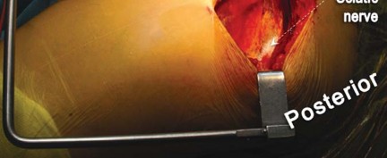 Illustration 28 for Birmingham Hip Resurfacing Designer's Technique for Active Lives