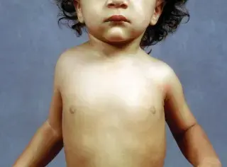 صورة توضيحية لـ تشوه سبرينغل: دليل شامل للمرضى والعائلات في اليمن والخليج العربي مع الأستاذ الدكتور محمد هطيف