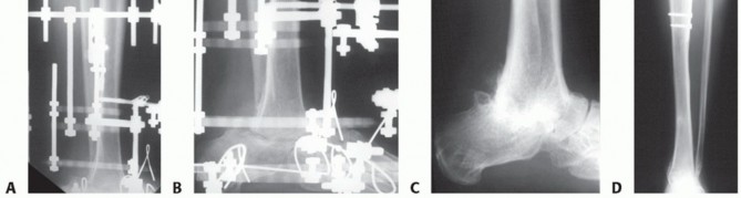 Illustration 26 for Beyond Amputation: Circular Fixation for Infection of the Talus