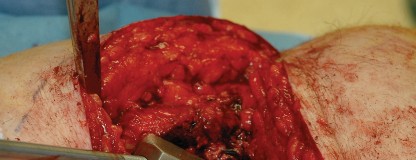 Illustration 10 for Femoral Stem Revision: Posterior Approach for Better Outcomes