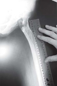 Illustration 17 for Successful Total Hip Replacement in Developmental Dysplasia