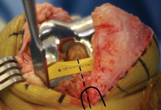 Illustration 8 for Optimize Tibial Component Alignment: Techniques for TKA Success