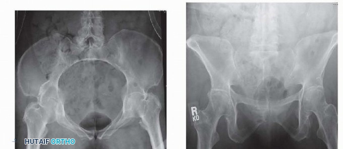 Illustration 3 for Achieve Stable Fixation of the Symphysis: Open Reduction
