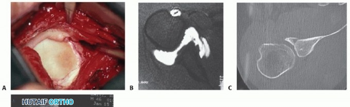 Illustration 4 for Bankart Repair & Inferior Capsular Shift: Solving Shoulder Instability