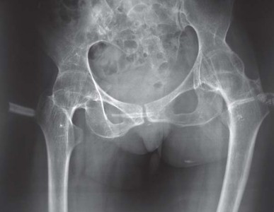 Illustration 47 for Total Hip Arthroplasty: Restoring Mobility in Juvenile Idiopathic Arthritis