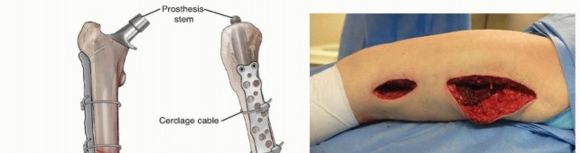 Illustration 25 for Mastering Fixation of Periprosthetic Fractures of the Femur