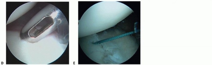 Illustration 5 for Finally Treat Recurrent Posterior Instability of the Shoulder