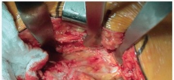 Illustration 4 for Unlock Precision: The Direct Lateral Approach for THA