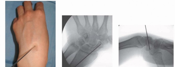 Illustration 3 for Mastering Percutaneous Fixation of Acute Scaphoid Fractures