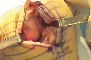 صورة طبية: جراحة استبدال مفصل الركبة الجزئي (UKA): تجنب الأخطاء والاستفادة القصوى في صنعاء مع الأستاذ الدكتور محمد هطيف