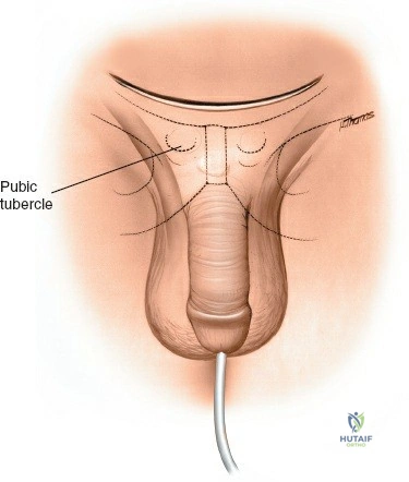 Illustration of approach to the pubic - Dr. Mohammed Hutaif