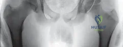 الشفاء من آلام الكاحل: الحل المتقدم لإصابات غضروف العرجون (Anterior Tibial Osteotomy)