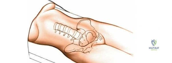 Illustration 1 for Expert Guide: Transperitoneal and Retroperitoneal Lumbar Access