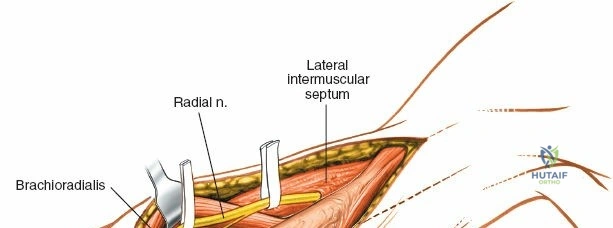 Distal Humerus Anterolateral Approach: Surgical Anatomy, Techniques, & Fracture Management