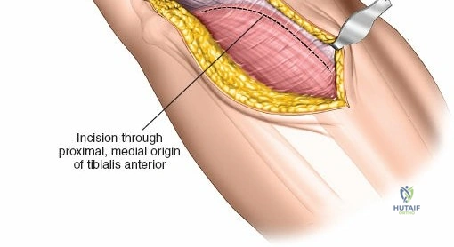 Illustration of approach to the lateral - Dr. Mohammed Hutaif