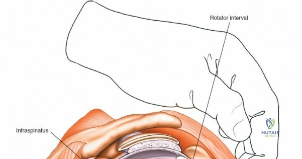 Illustration of shoulder arthroscopic approaches - Dr. Mohammed Hutaif