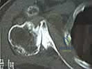 Arthroscopic Management of Cam-Type Femoroacetabular Impingement: A Comprehensive Surgical Guide