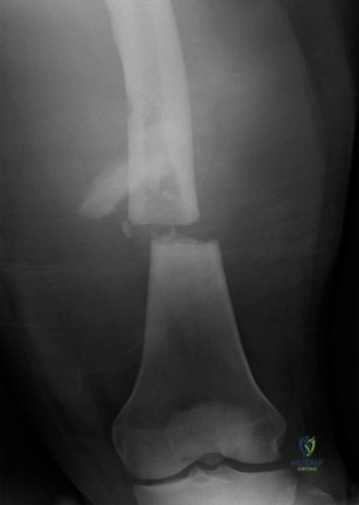Illustration of shaft and neck - Dr. Mohammed Hutaif