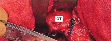 صورة توضيحية لـ إتقان توازن الأنسجة الرخوة لمفصل ورك صناعي مثالي: دليل شامل للمرضى مع الأستاذ الدكتور محمد هطيف