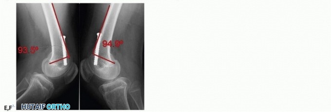 Illustration 14 for Optimizing Growth to Correct Pediatric Limb Deformities