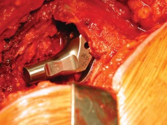 Illustration 31 for S-ROM: Inside the Technique of Modular Implant Design