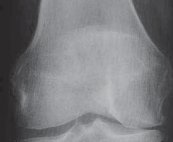 Illustration 45 for Guide Pin Assembly: Key to Flawless Upper Tibial Osteotomy