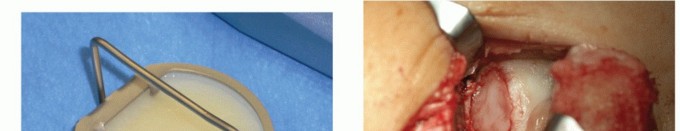 Illustration 10 for Restore Damaged Cartilage with Autologous Chondrocyte Transplantation