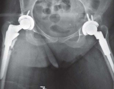 Illustration 153 for Successful Total Hip Replacement in Developmental Dysplasia