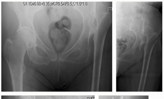 Illustration 6 for Mastering Femoral Head Autograft in DDH Hip Reconstruction