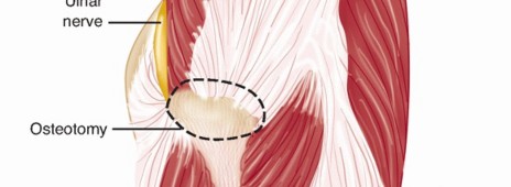 Illustration 34 for Surgical Approaches to Shoulder & Elbow: Pearls and Pitfalls