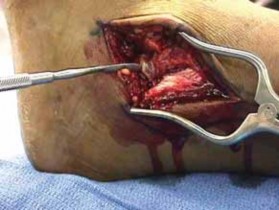 Illustration 19 for Talar Neck Fracture Treatment: Optimizing Recovery with ORIF