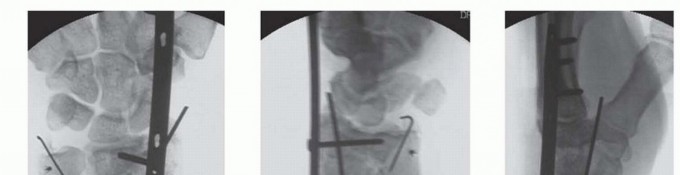 Bridge Plating: The Key to Challenging Plating of Distal Fractures