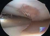 Illustration 12 for Microfracture Chondroplasty: How Tiny Holes Are Made to Fix Cartilage