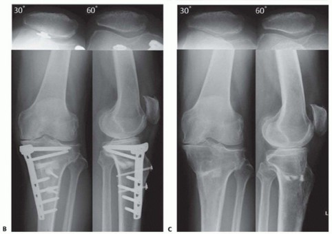 Illustration 27 for High Tibial Osteotomy: Realignment for Lasting Knee Pain Relief