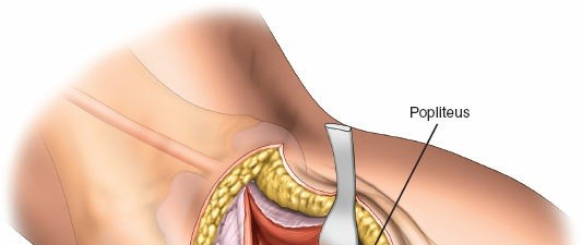 Illustration 45 for Surgical Access: Mastering the Tibia's Surface & Fibula Approaches
