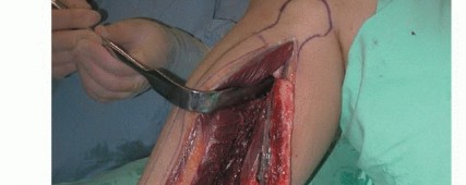 Illustration 23 for Free Vascularized Fibular Grafts: Solving Complex Bone Defects