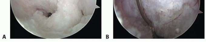 Illustration 15 for Posterior Cruciate Ligament Surgery: Regain Knee Strength & Stability