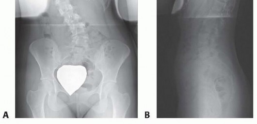 Illustration 2 for Anterior Interbody Arthrodesis for Scoliosis: What You Need to Know
