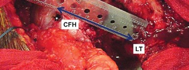 صورة طبية: إتقان توازن الأنسجة الرخوة لمفصل ورك صناعي مثالي: دليل شامل للمرضى مع الأستاذ الدكتور محمد هطيف