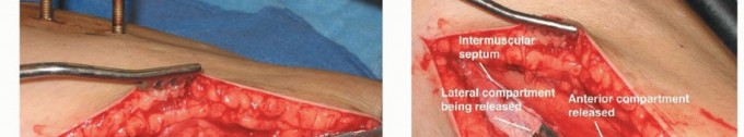 Illustration 13 for Acute Compartment Syndrome: Timely Fasciotomy Explained